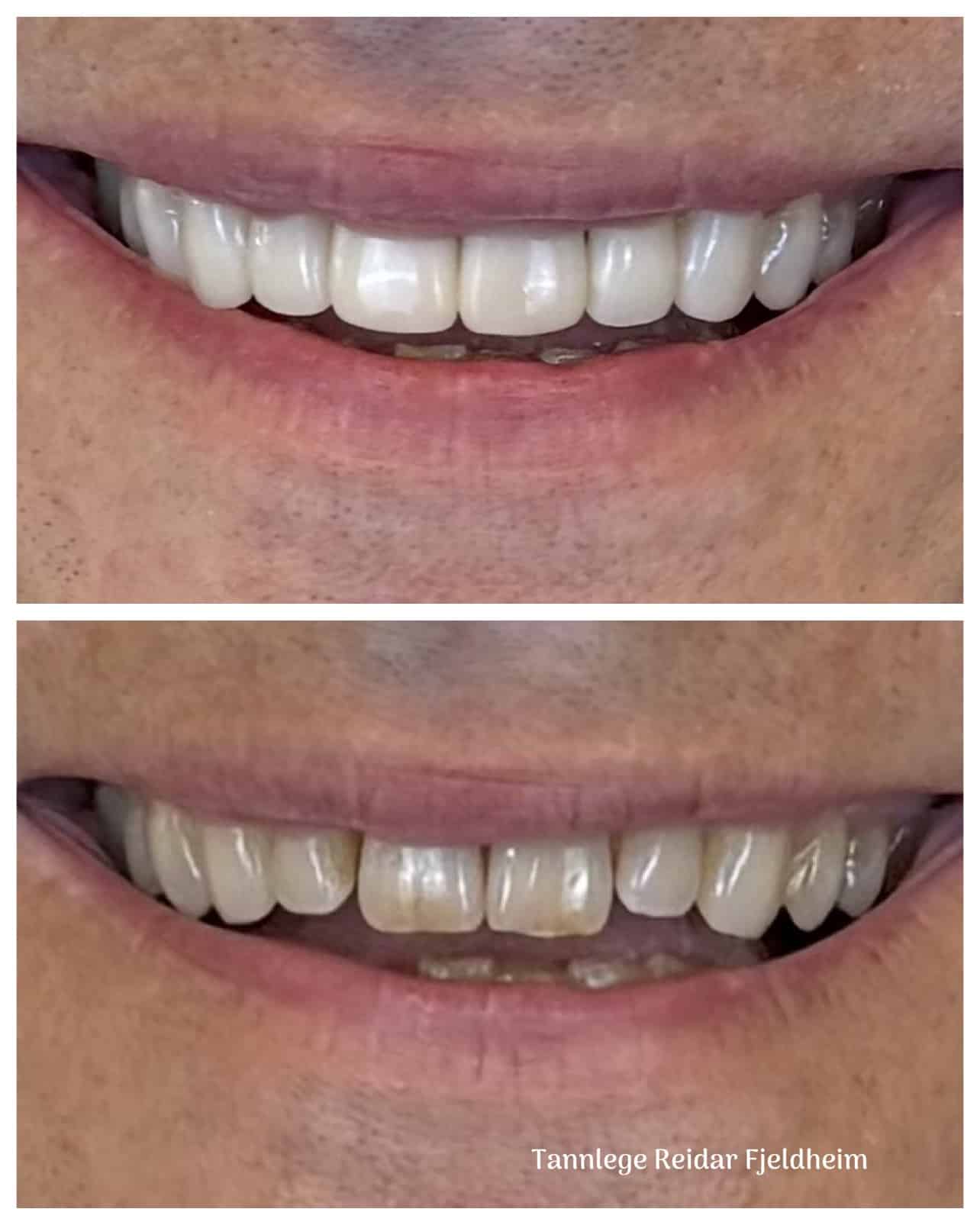 Skallfasetter i kompositt