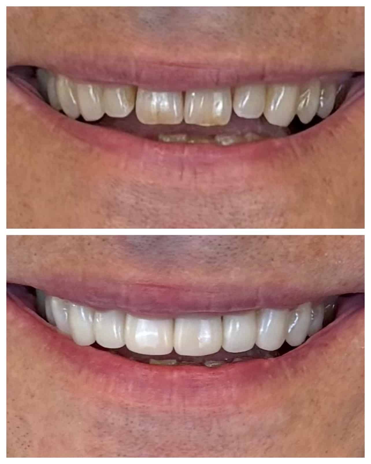 Før og etter – Invisalign