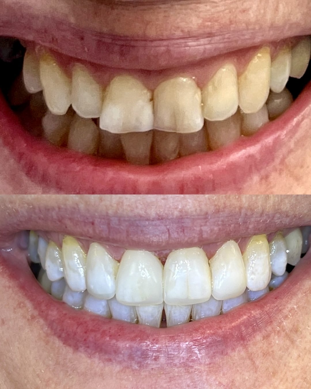 Før og etter – tannstilling